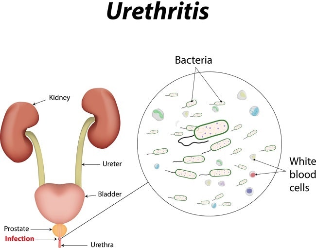 Prostatit urethritis