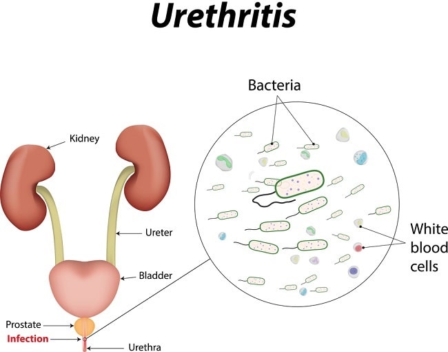 Prostatit urethritis)