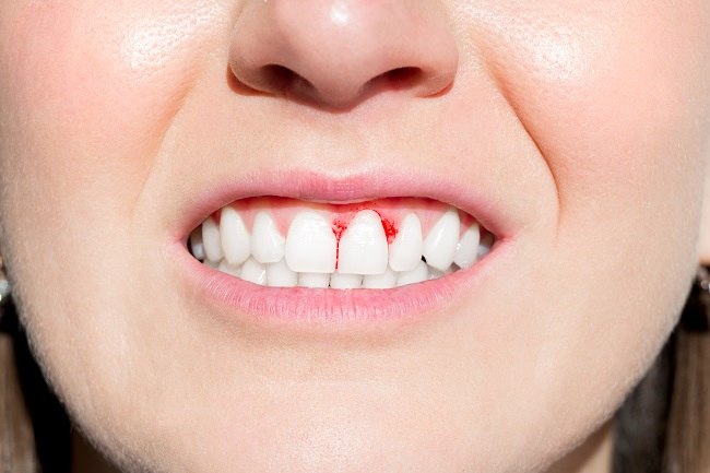 Terrible tooth ache.