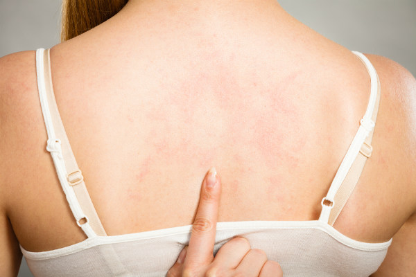 Alcohol Allergy