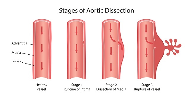 diseksi aorta