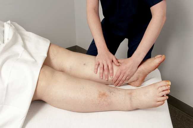 Lymphedema - อาการ, สาเหตุ, การรักษา - พบแพทย์ Lymphedema - อาการ, สาเหตุ, การรักษา - พบแพทย์