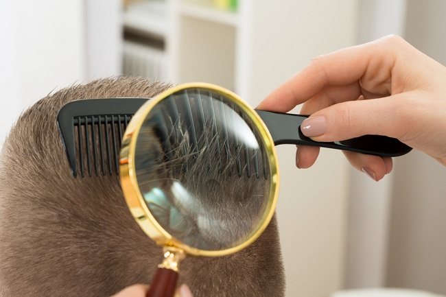 5 Cara Menghilangkan Kutu Rambut dengan Mudah - Alodokter