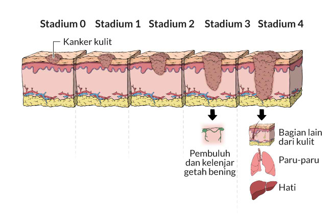 Alodokter - Kanker Kulit Melanoma