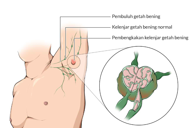 Alodokter - Pembengkakan Kelenjar Getah Bening