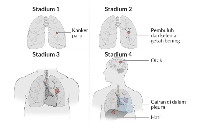 Alodokter - Kanker Paru