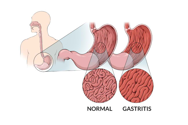 Gastritis Merupakan Panyakit Karena Gangguan ? / Mengenal Penyakit Gastritis Radang Lambung Yang ...