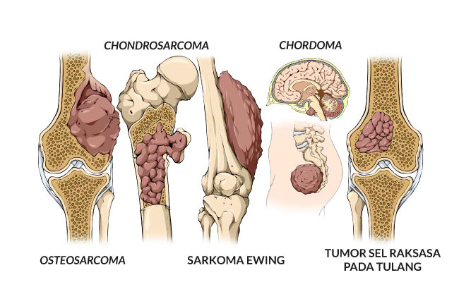 Kanker Tulang - Gejala, penyebab dan mengobati - Alodokter