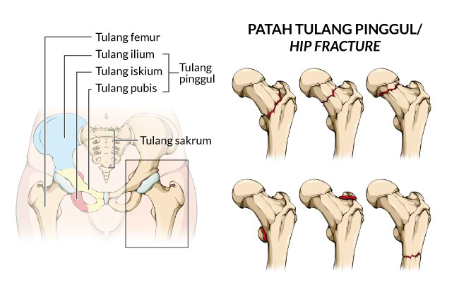 Alodokter - Patah Tulang Pinggul