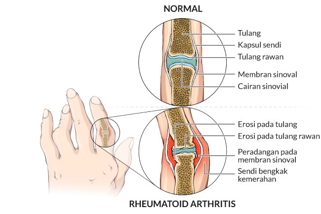 Alodokter - reumatoid-artritis
