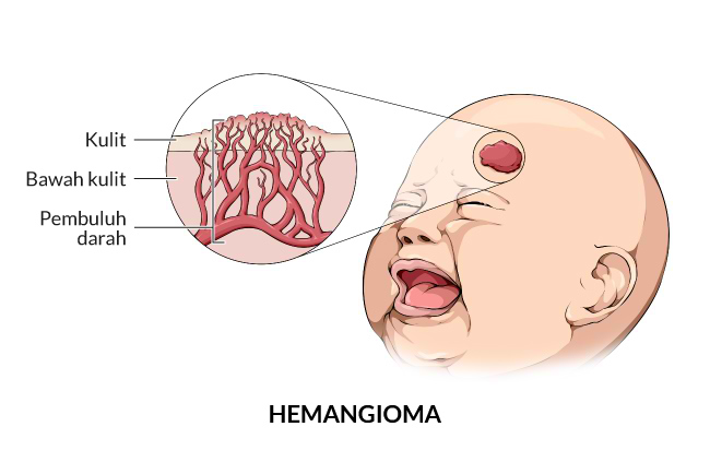 Alodokter - hemangioma