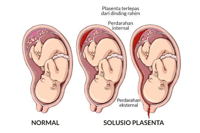 Alodokter - solusio-plasenta