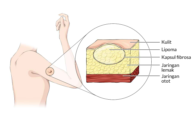 Alodokter - lipoma