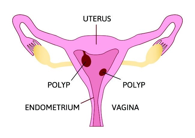Alodokter - Polip Rahim
