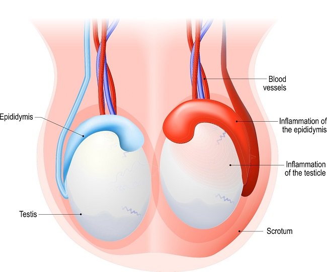 Epididymitis - alodokter