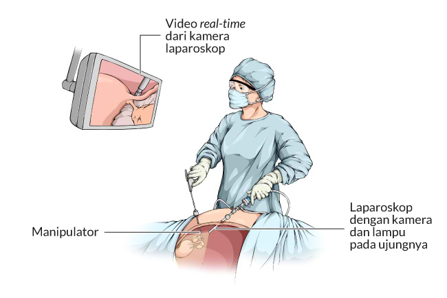 Kelebihan Teknik Bedah Laparoskopi - Alodokter