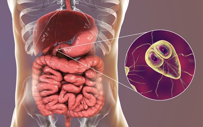 giardiasis treatment uk szalagféreg kép