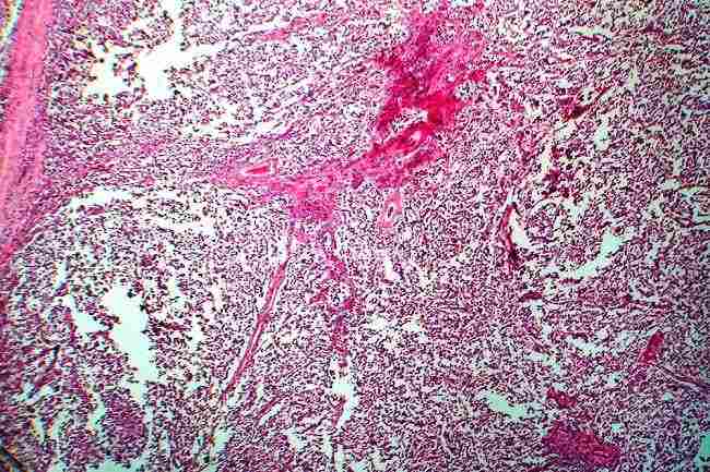 Seminoma Testis - patofisiologi, diagnosis, penatalaksanaan - Alomedika