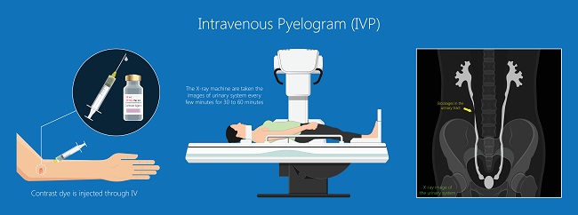 Intravenous Pyelography - teknik, indikasi, komplikasi, pedoman klinis ...
