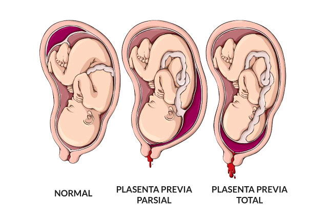 alodokter-plasenta-previa