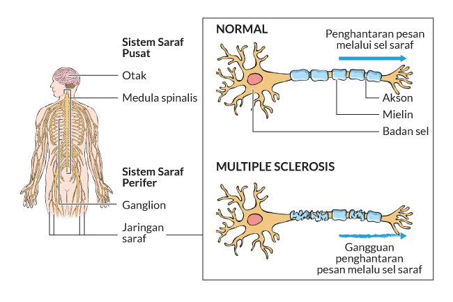 alodokter-multiple-sclerosis