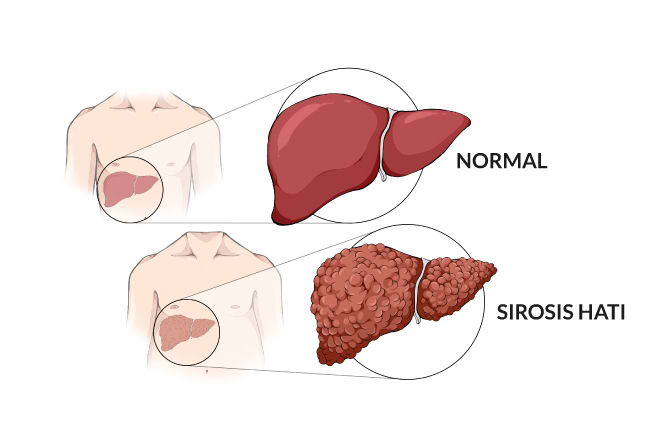 Sirosis-Alodokter