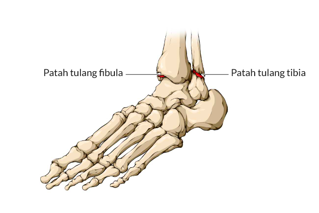 patah pergelangan kaki - Alodokter