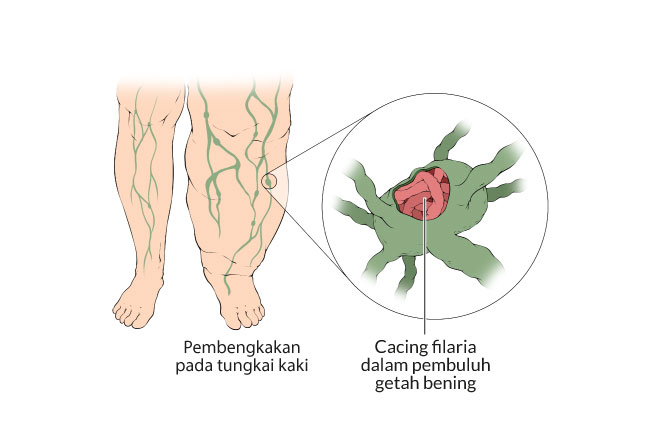 Kaki Gajah Gejala Penyebab Dan Mengobati Alodokter