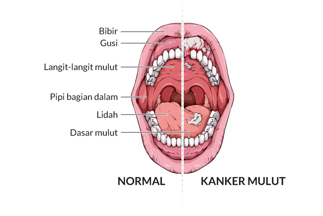alodokter-kanker-mulut