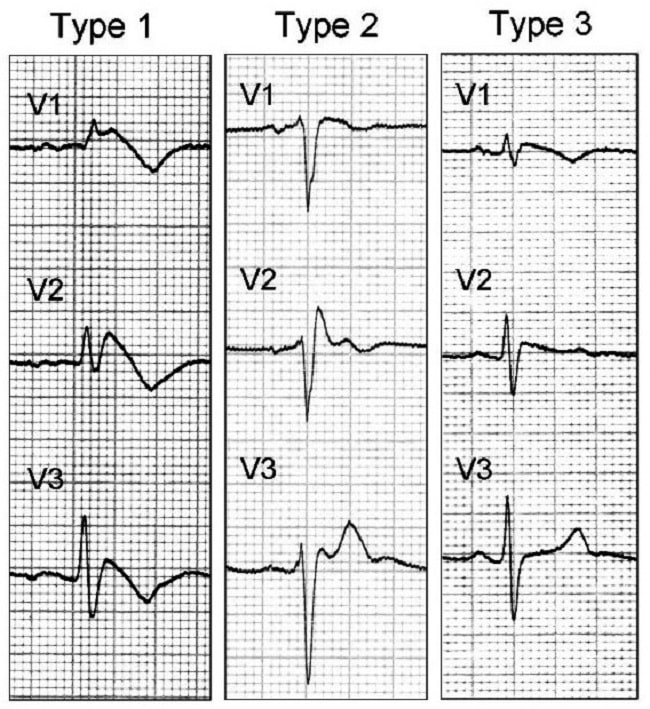Gambar 1. Pola Gambaran EKG SIndrom Brugada. Sumber Gambar: Napolitano C, Priori SG, WIkimedia Commons, 2008.