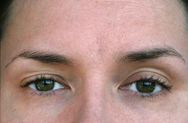 Seputar Ptosis, Gangguan pada Kelopak Mata - Alodokter