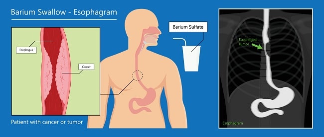 Teknik Barium  Swallow X Ray Alomedika