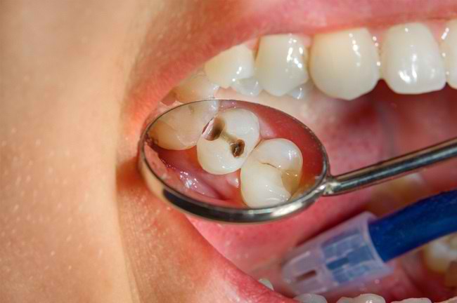 Risiko dan Bahaya Penyakit Gigi Berlubang - Alodokter