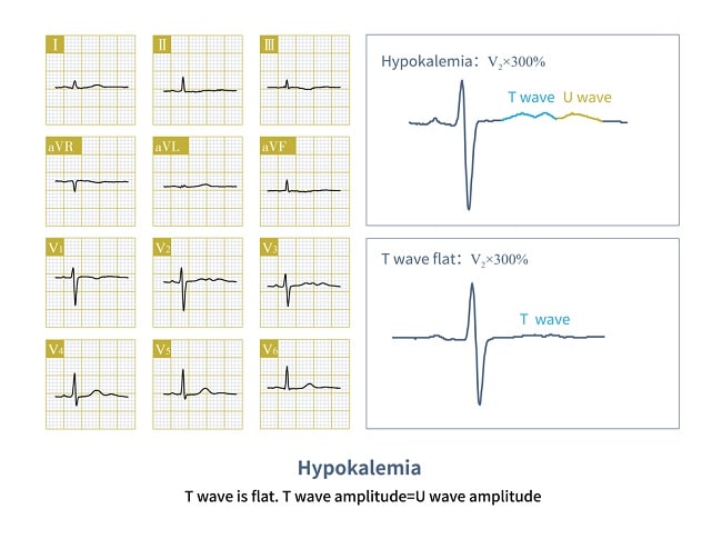 Gambaran ekg hiperkalemia