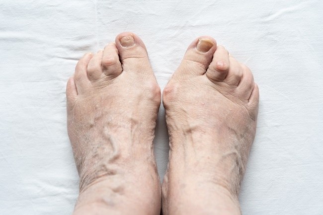 Hammer Toe - Alodokter