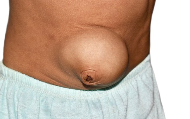 umbilical hernia - alodokter
