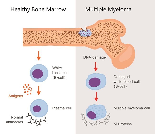 Multiple myeloma - alodokter