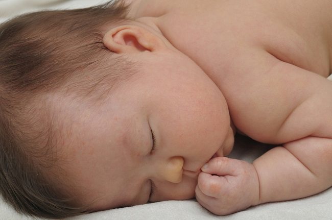 Gastroschisis - alodokter