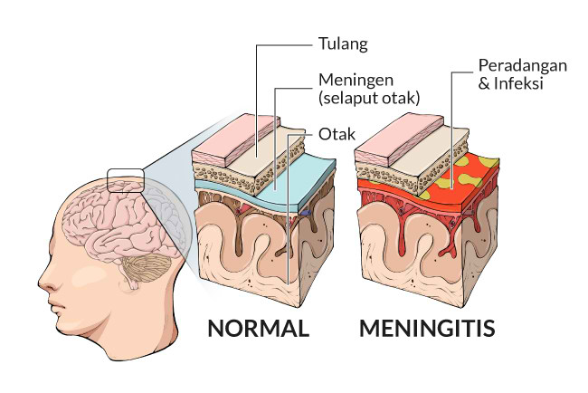 Meningitis, radang selaput otak