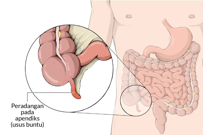 Penyakit usus buntu, gejala, penyebab, cara mencegah, cara mengobati, alodokter