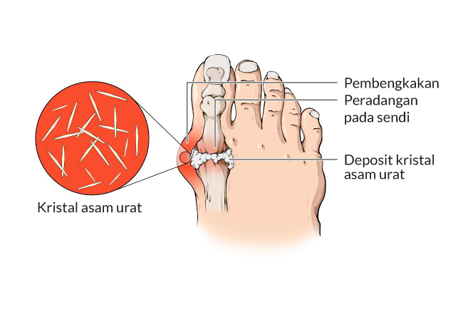 Asam Urat Gejala Penyebab Dan Pengobatan Alodokter 9222