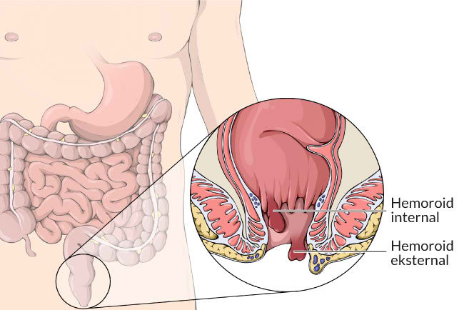 Hemoroid adalah pembengkakan vena di daerah