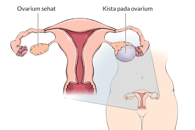 Penyakit kista disebabkan oleh apa