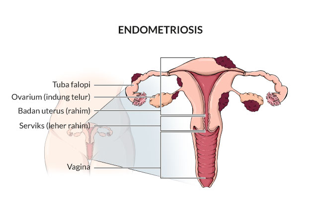 endometriosis, gejala, penyebab, cara mencegah, cara mengobati, alodokter