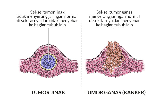 Perbedaan Kanker Sarkoma dengan Kanker Rahim