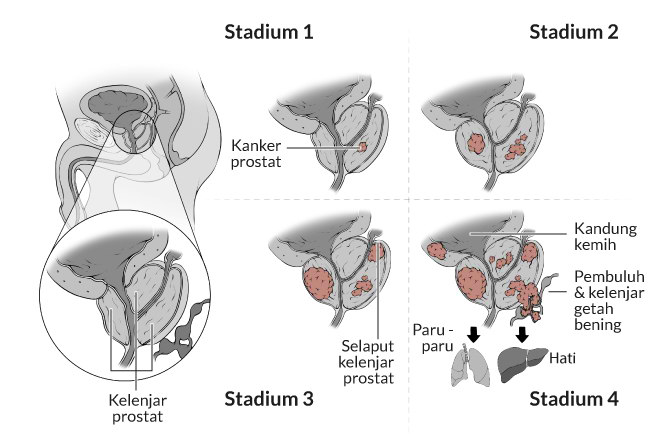 Penyebab Kanker Prostat Alodokter