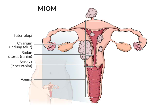 Miom Gejala Penyebab Dan Mengobati Alodokter 1471