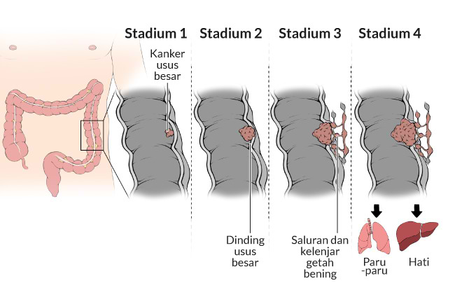 Kanker Usus Besar Gejala Penyebab Dan Mengobati Alodokter