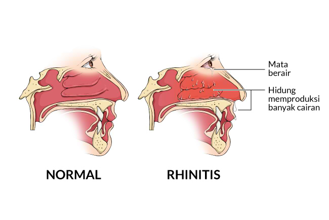 Rhinitis - Gejala, penyebab dan mengobati - Alodokter