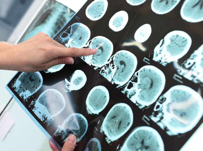 Patah Tulang Tengkorak, Kenali Gejala dan Cara Mengobatinya - Alodokter